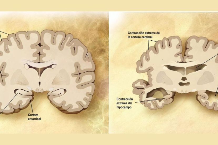 Cerebro corte frontal Alzheimer